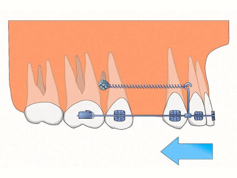 Le traitement Minivis Orthodontiste Yvelines Dr SAMAMA à Paris 78110 Vésinet Boucle de seine Pecq Croissy Chatou Houille Montesson Marly Maison Laffitte invisalign