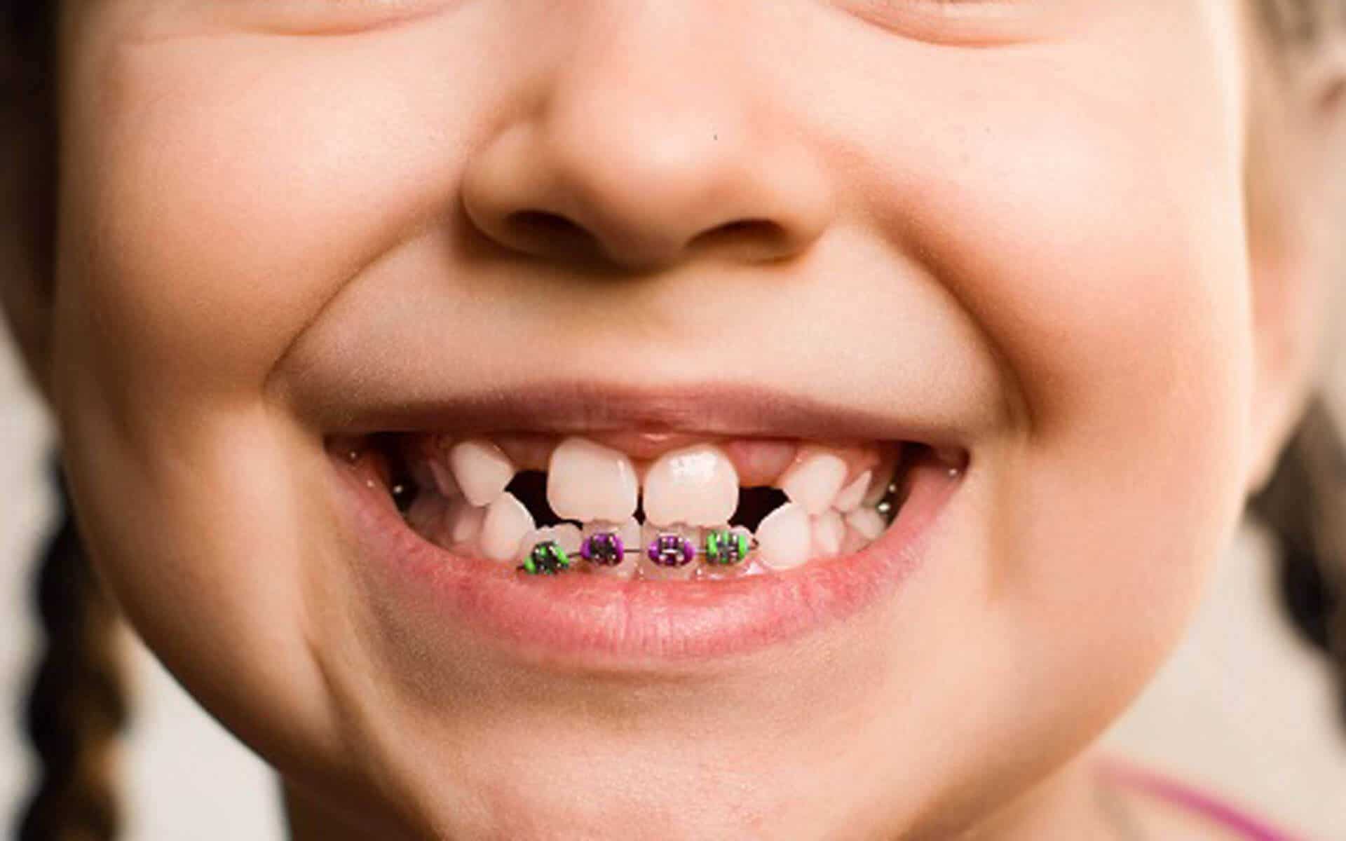 A partir de 7 ans la première consultation Docteur Samama Orthodontiste Yvelines chirurgie dentaire orthodontie en Yvelines dental monotoring