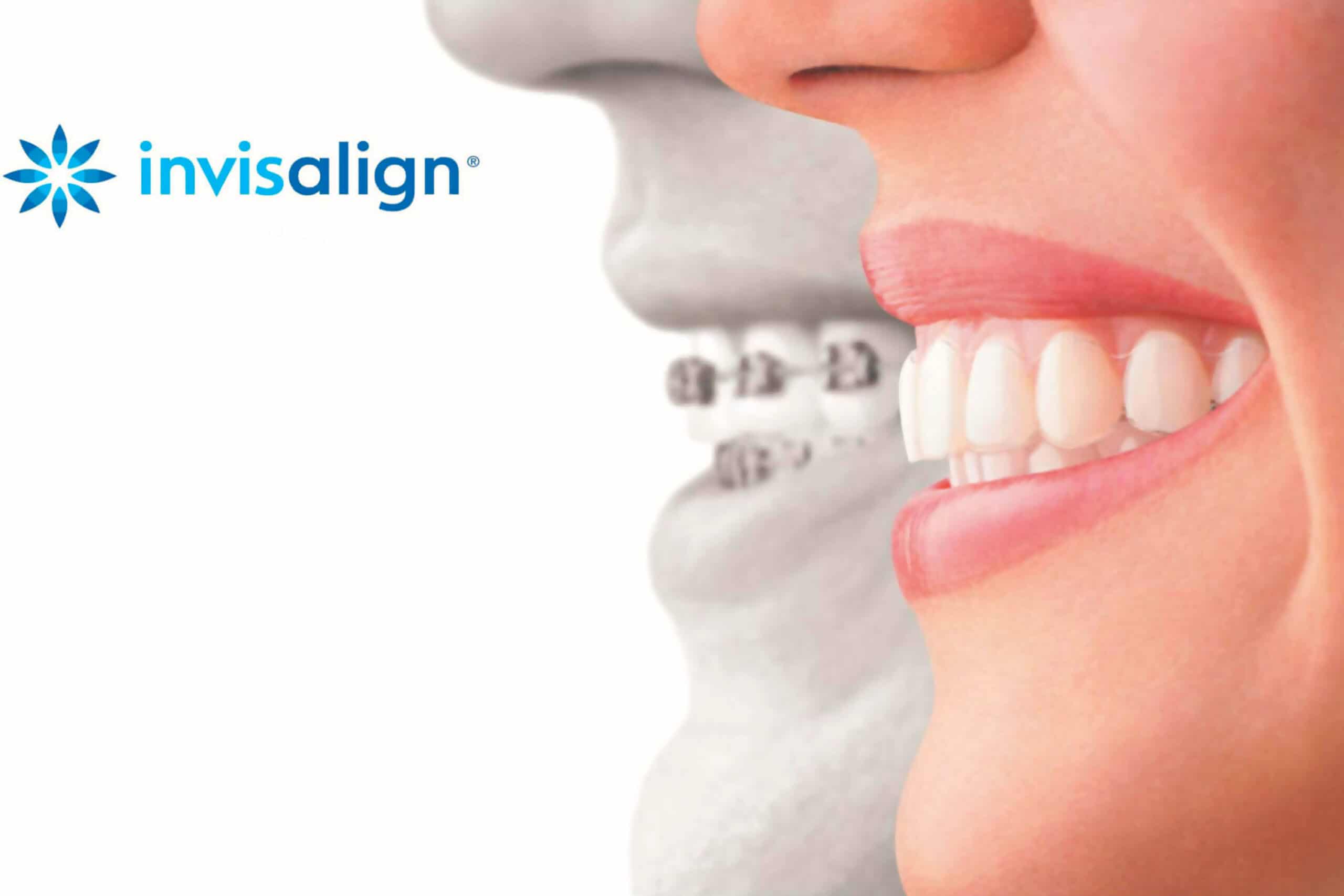 Invisaligne Docteur Samama Orthodontiste Yvelines chirurgie dentaire orthodontie en Yvelines dental monotoring