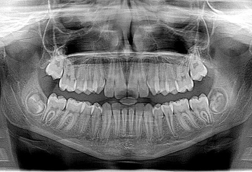 Docteur Samama Orthodontiste e-consultation dents de face orthodontiste Vesinet Boucle de seine Pecq Croissy Chatou Houille Montesson Marly Maison Laffitte invisalign