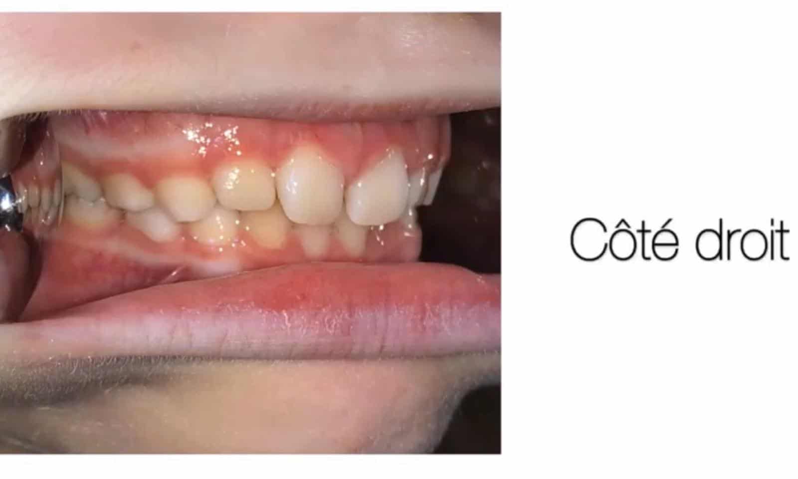 Docteur Samama Orthodontiste e-consultation dents de face orthodontiste Vesinet Boucle de seine Pecq Croissy Chatou Houille Montesson Marly Maison Laffitte invisalign