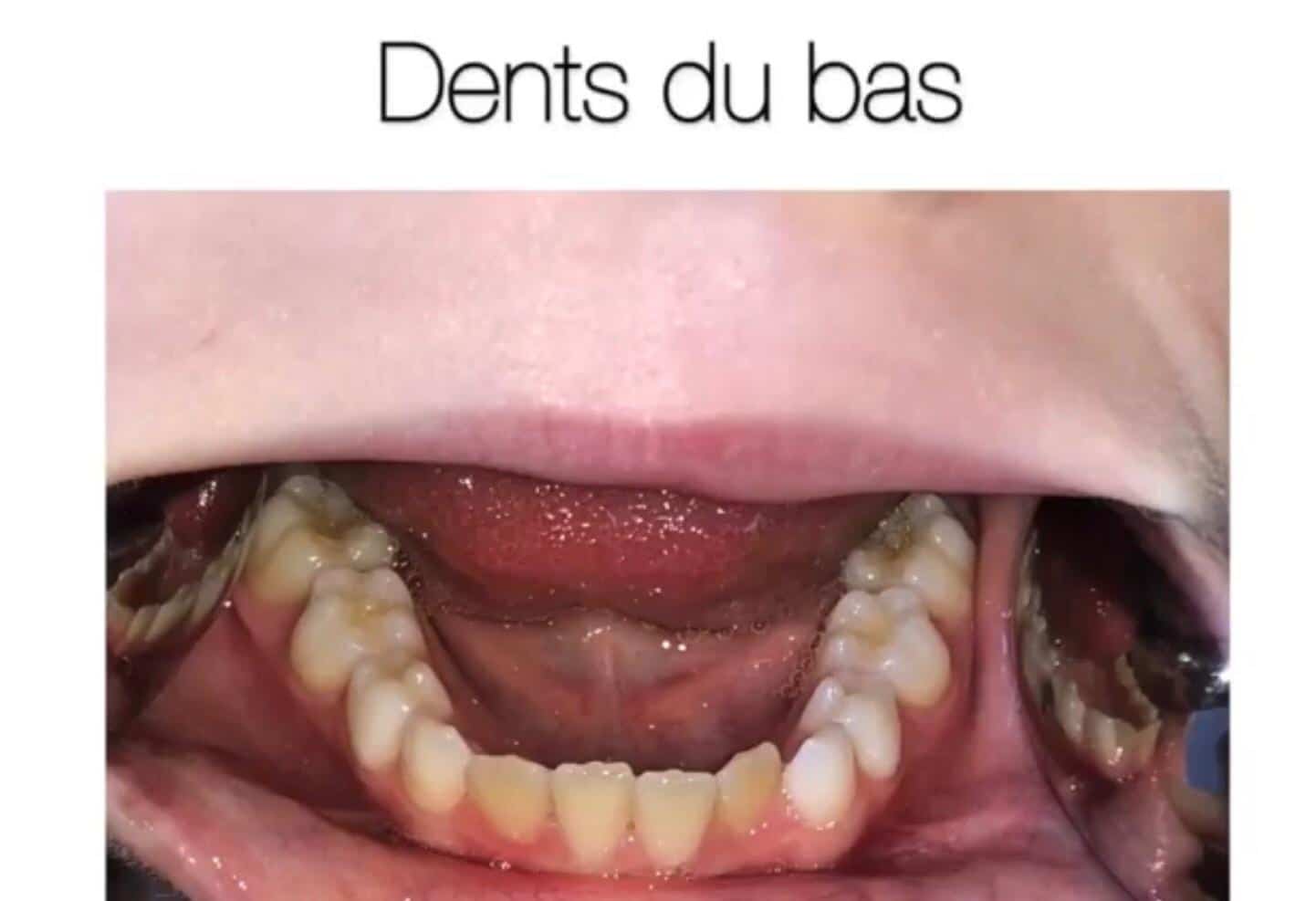 Docteur Samama Orthodontiste e-consultation dents de face orthodontiste Vesinet Boucle de seine Pecq Croissy Chatou Houille Montesson Marly Maison Laffitte invisalign