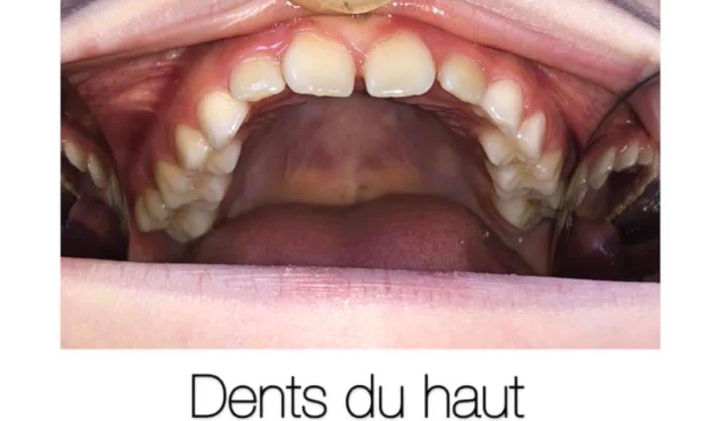 Docteur Samama Orthodontiste e-consultation dents de face orthodontiste Vesinet Boucle de seine Pecq Croissy Chatou Houille Montesson Marly Maison Laffitte invisalign