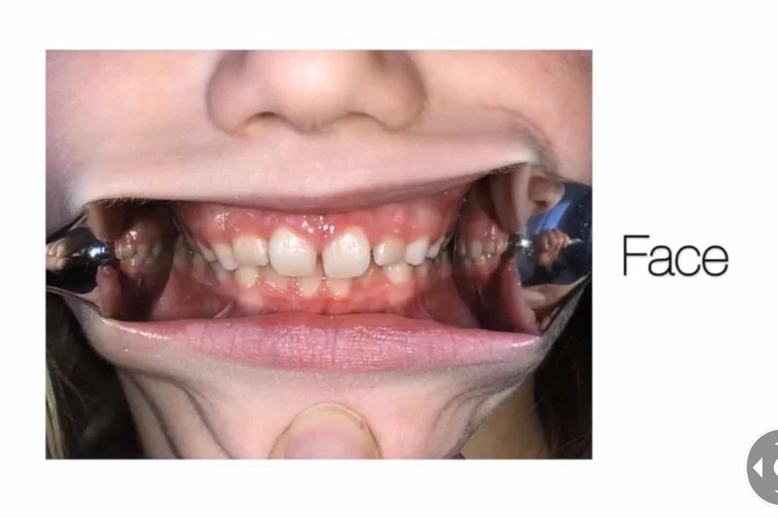 Docteur Samama Orthodontiste e-consultation dents de face orthodontiste Vesinet Boucle de seine Pecq Croissy Chatou Houille Montesson Marly Maison Laffitte invisalign